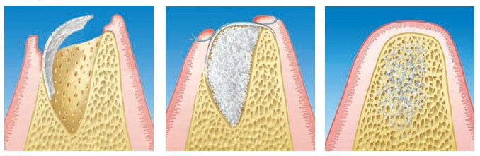 rigenerazione_ossea_denti_napoli