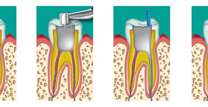 Endodonzia_fuorigrotta